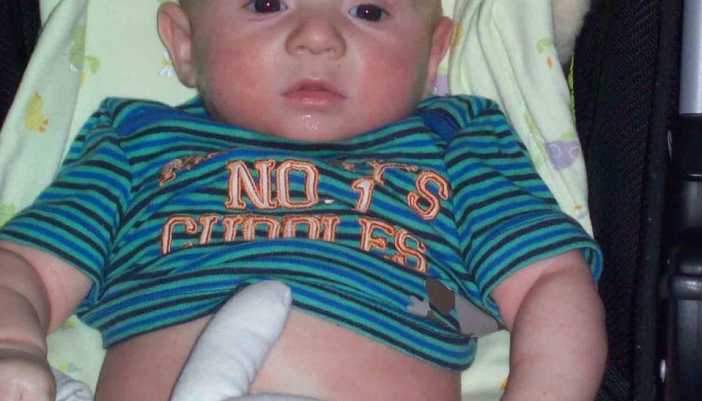 https://www.writteninwaikiki.com/eczema-the-itchy-condition-that-takes-over-your-life/ child baby with eczema rash on skin