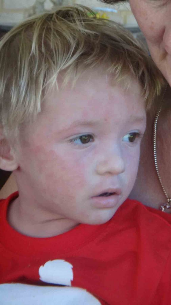 https://www.writteninwaikiki.com/eczema-the-itchy-condition-that-takes-over-your-life/ boy child toddler with eczema skin rash on face