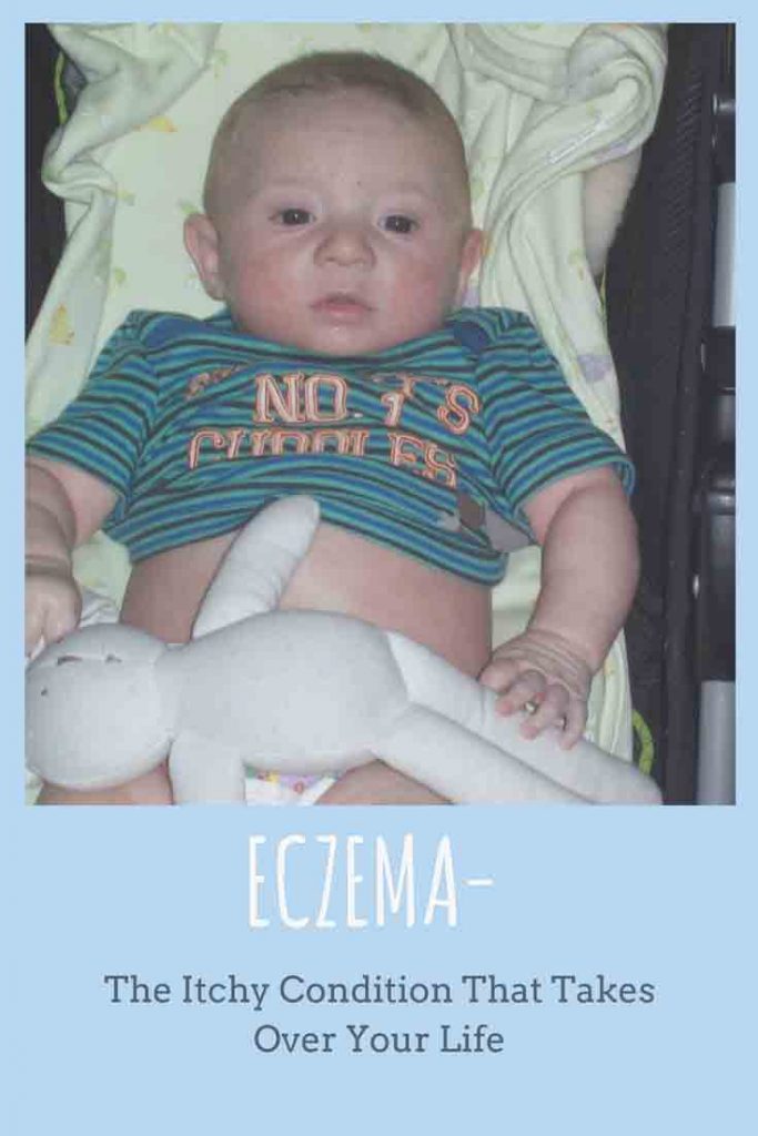 https://www.writteninwaikiki.com/wp-content/uploads/2018/04/Eczema-a-.jpg baby with eczema