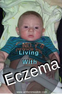 living with eczema baby child pinterest